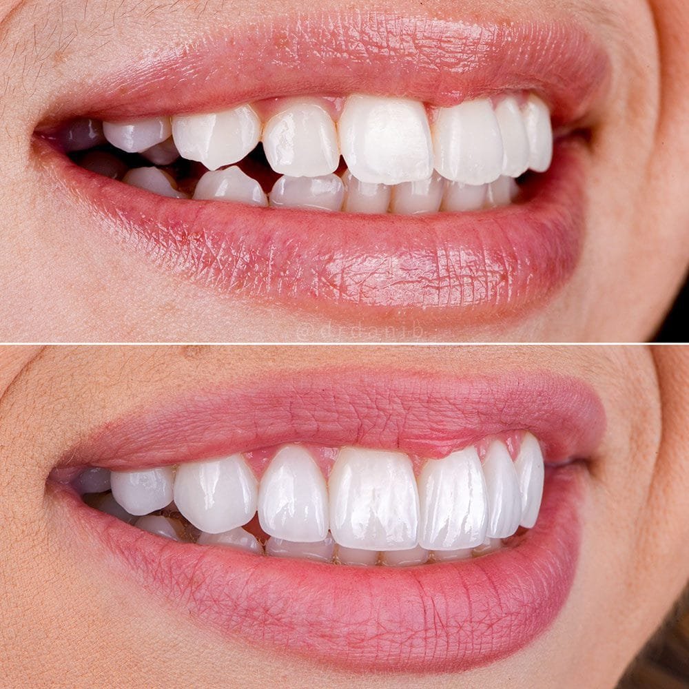 Dental veneers 2 Dental veneers dentalnobel