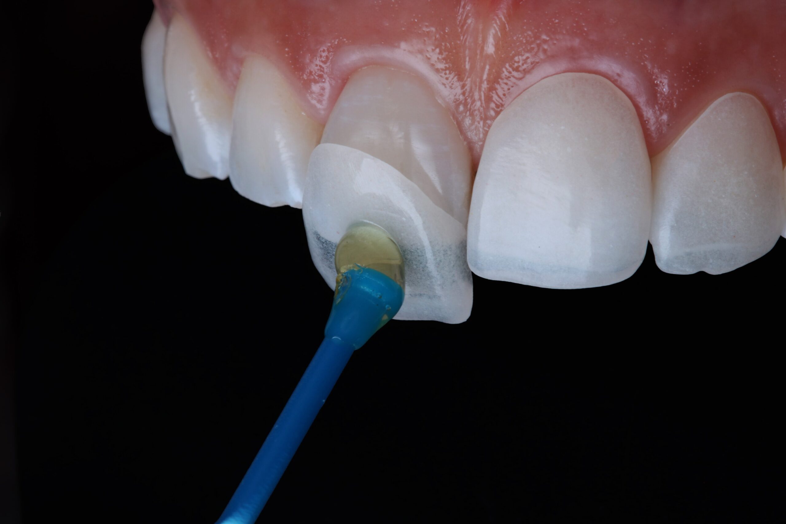 dental-veneers-dentalnobel