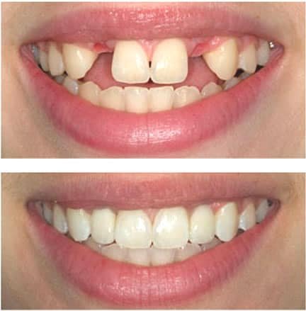 implants dentalnobel