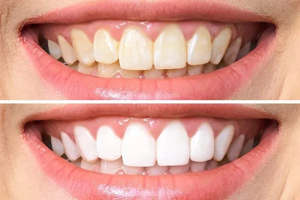 teeth-whitening-dentalnobel